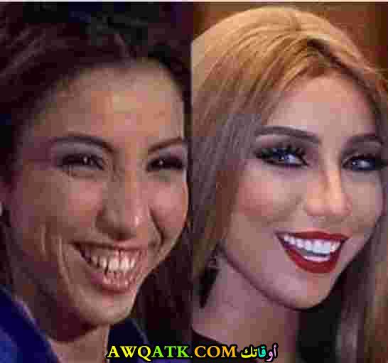 دنيا بطمة قبل التجميل